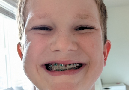 Picture of a boy smiling with braces